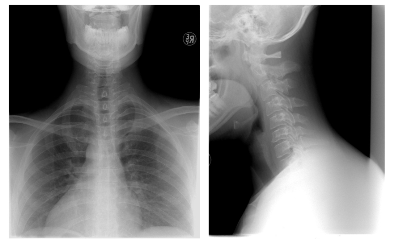 Neck X Ray