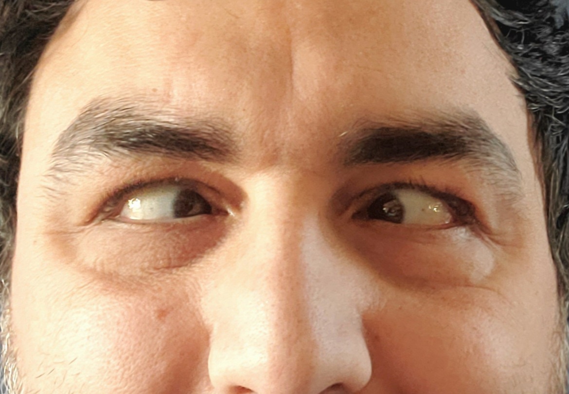 crosseyed
